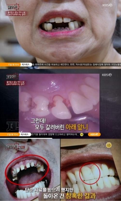 제보자들 치과 과잉진료 논란 (사진: KBS 2TV '제보자들')
